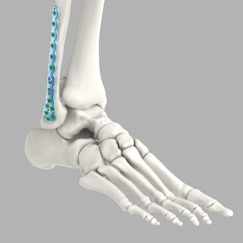 Lateral Distal Fibula Plate Ankle System