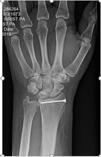 distal-radius-articular-fracture-post-op distal-radius-articular-fracture-post-op